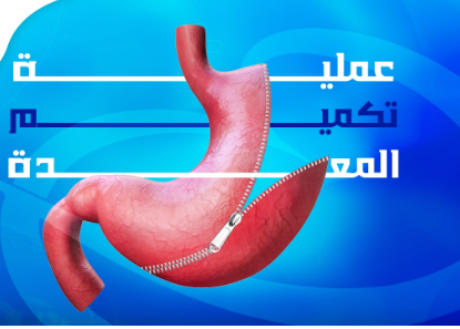 تكميم معدة طبيعى